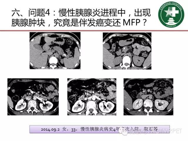 【PPT】肿块性胰腺炎影像诊断和鉴别诊断