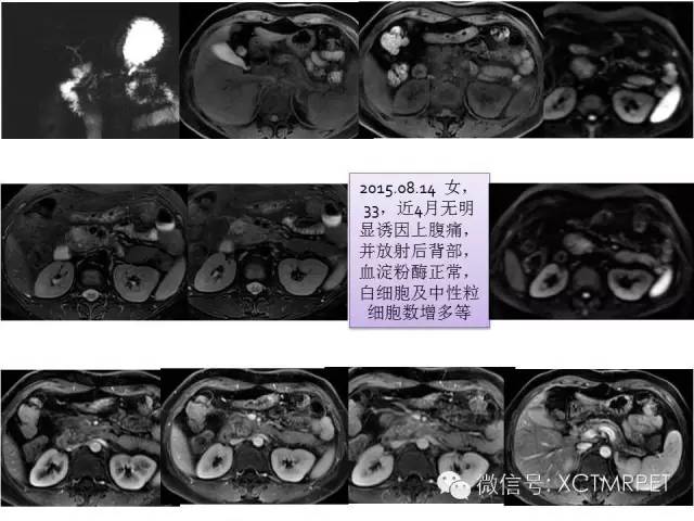 【PPT】肿块性胰腺炎影像诊断和鉴别诊断