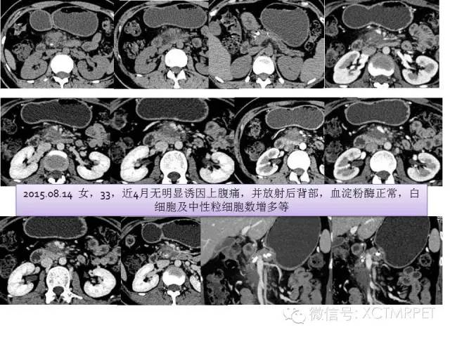 【PPT】肿块性胰腺炎影像诊断和鉴别诊断