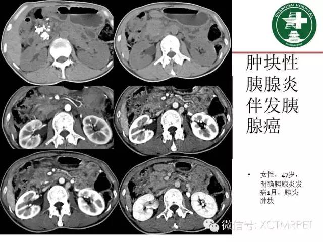 【PPT】肿块性胰腺炎影像诊断和鉴别诊断