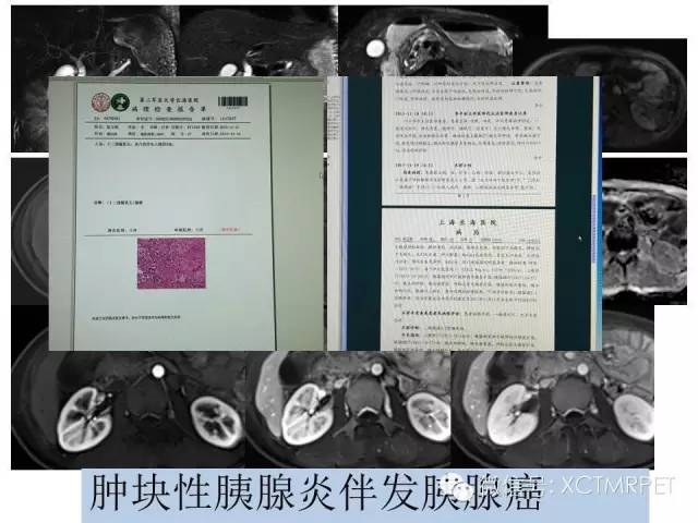 【PPT】肿块性胰腺炎影像诊断和鉴别诊断