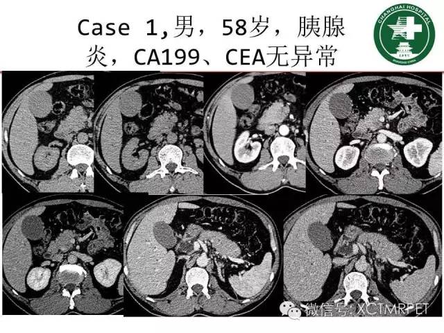 【PPT】肿块性胰腺炎影像诊断和鉴别诊断