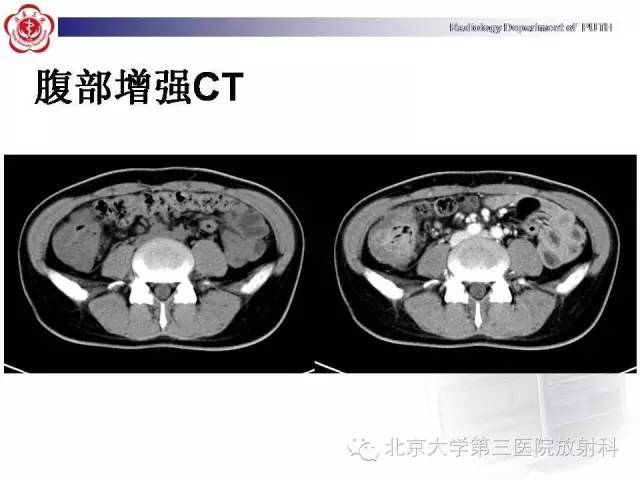 【病例】肠道白塞氏病1例X线CT