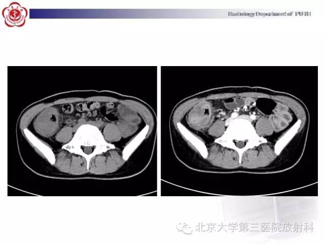【病例】肠道白塞氏病1例X线CT