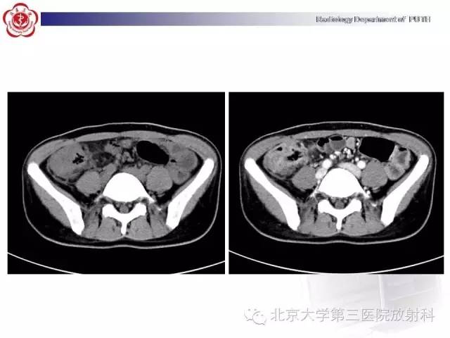 【病例】肠道白塞氏病1例X线CT