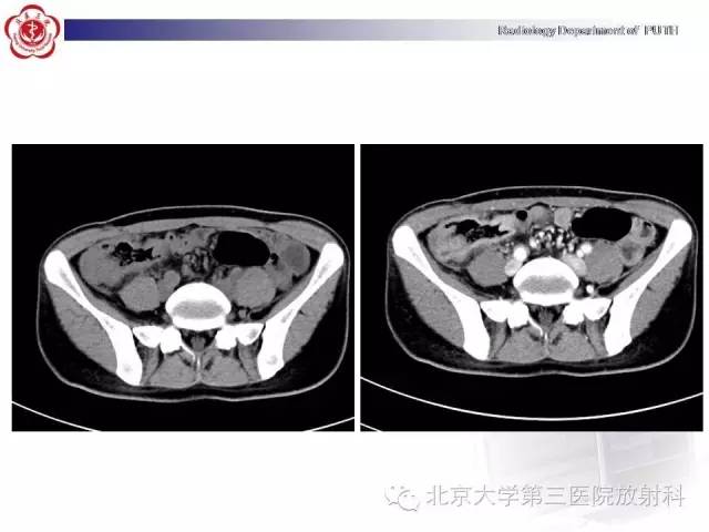 【病例】肠道白塞氏病1例X线CT
