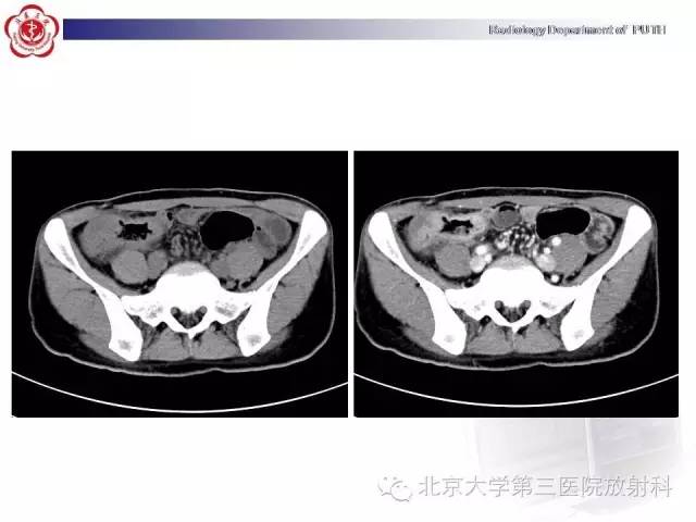 【病例】肠道白塞氏病1例X线CT