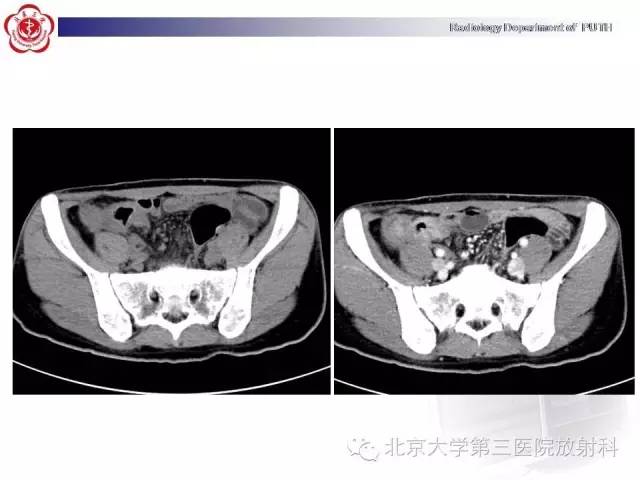 【病例】肠道白塞氏病1例X线CT