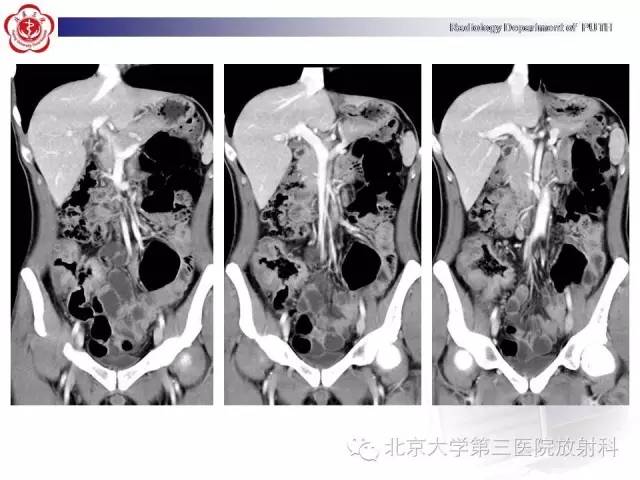 【病例】肠道白塞氏病1例X线CT