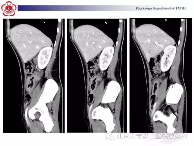 【病例】肠道白塞氏病1例X线CT
