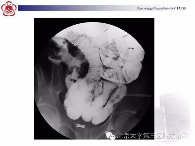 【病例】肠道白塞氏病1例X线CT