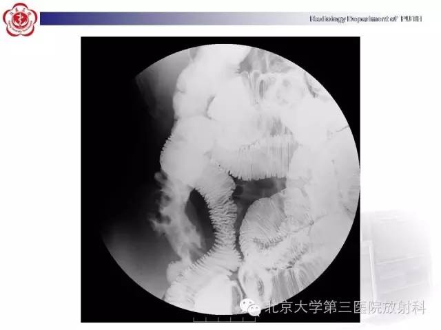 【病例】肠道白塞氏病1例X线CT