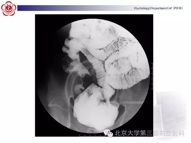 【病例】肠道白塞氏病1例X线CT