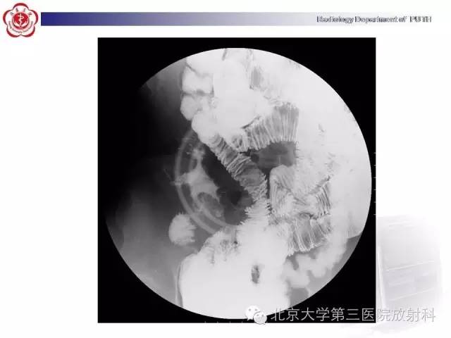 【病例】肠道白塞氏病1例X线CT