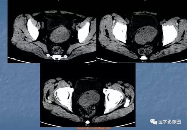 【病例】宫颈癌1例CT影像表现
