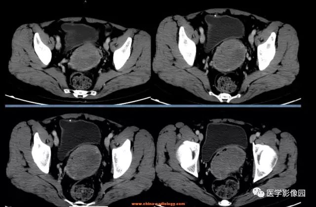 【病例】宫颈癌1例CT影像表现
