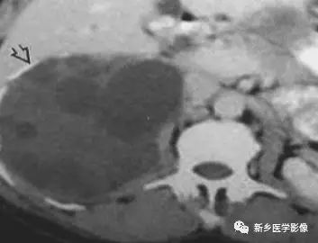 腹部平片看到高密度，你能想到这30种疾病吗？