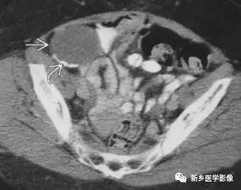 腹部平片看到高密度，你能想到这30种疾病吗？