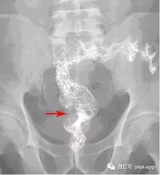 【病例】直肠癌1例X线CT影像表现