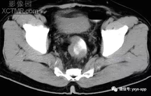 【病例】直肠癌1例X线CT影像表现
