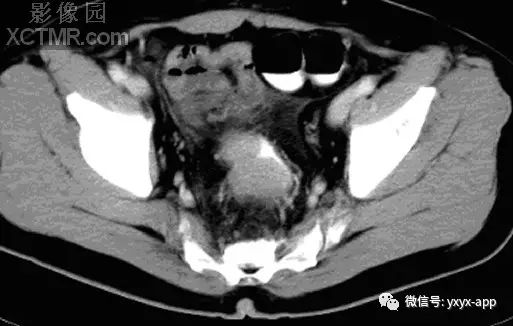 【病例】直肠癌1例X线CT影像表现
