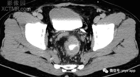 【病例】直肠癌1例X线CT影像表现