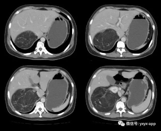 【病例】肾脏血管平滑肌脂肪瘤1例CT