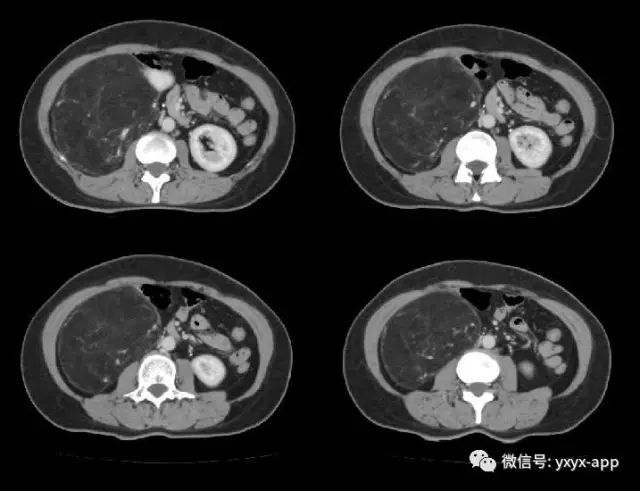 【病例】肾脏血管平滑肌脂肪瘤1例CT