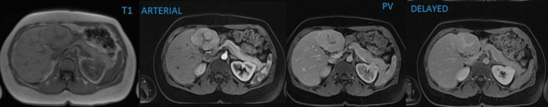 肝脏局灶性结节增生 「FNH」 影像特点