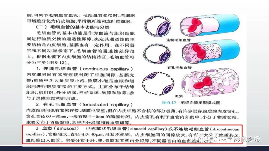 【病例】脾脏窦岸细胞血管瘤2例影像诊断-23