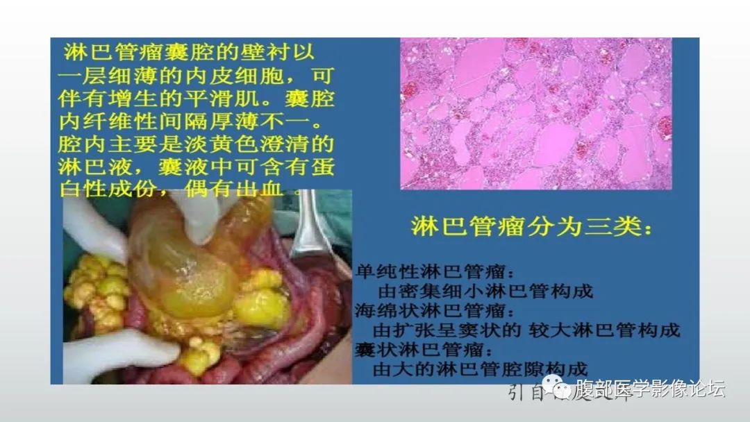 【病例】脾脏窦岸细胞血管瘤2例影像诊断-30