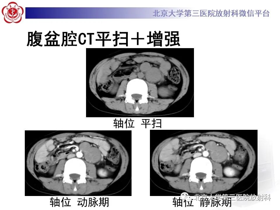 【PPT】卵巢无性细胞瘤-4