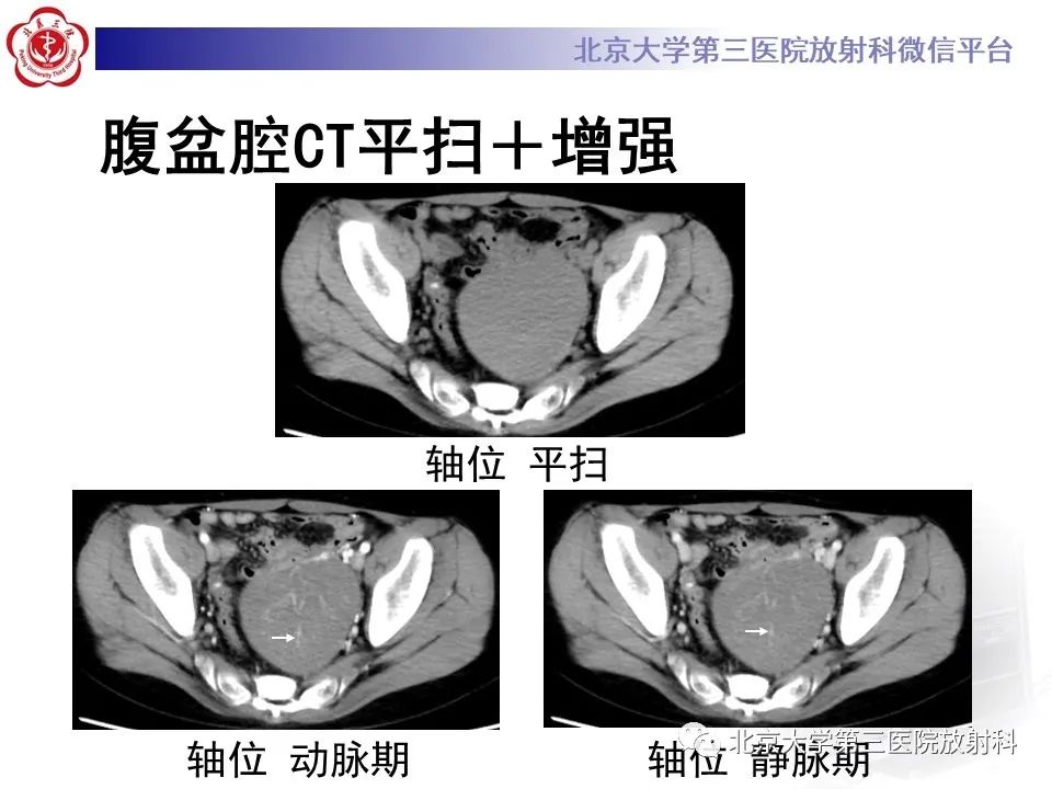 【PPT】卵巢无性细胞瘤-3