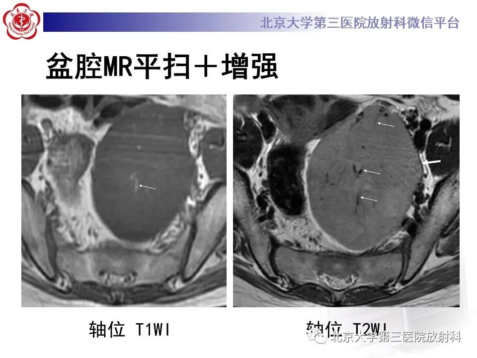 【PPT】卵巢无性细胞瘤-6