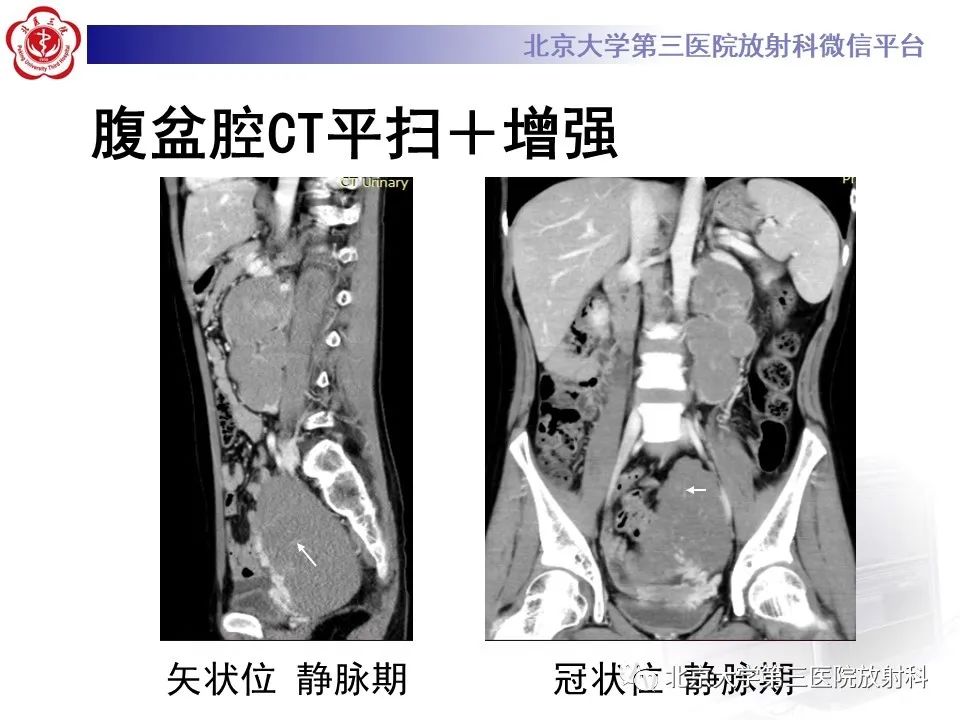 【PPT】卵巢无性细胞瘤-5