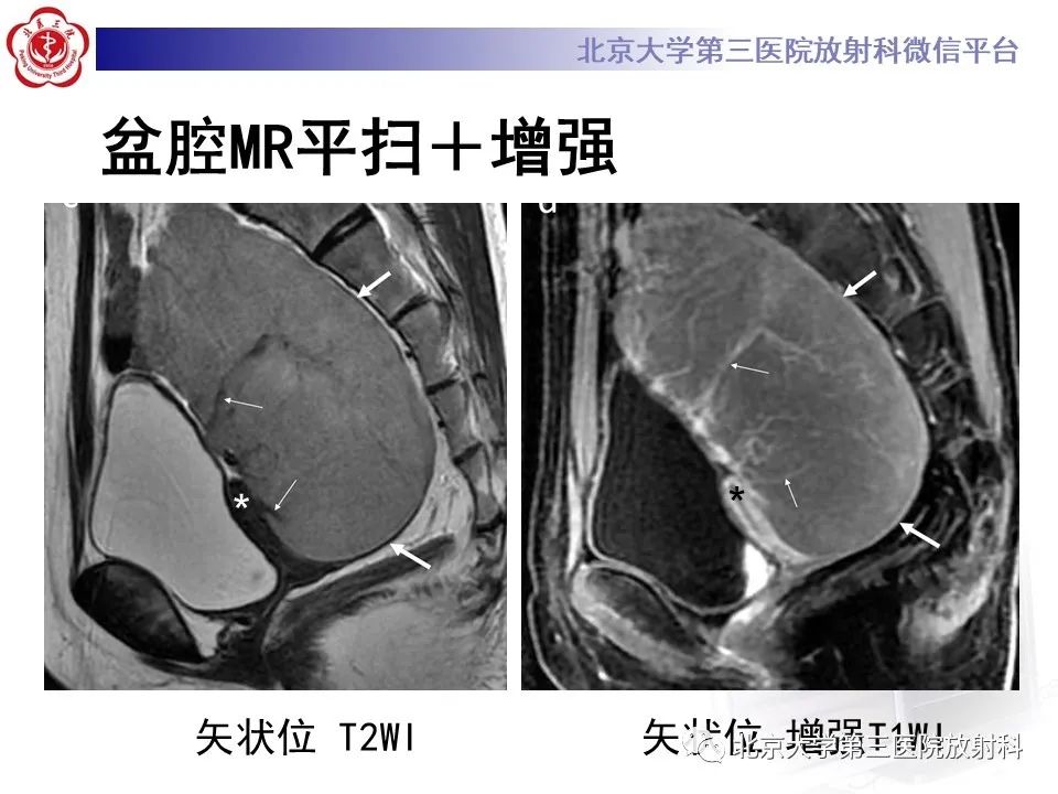 【PPT】卵巢无性细胞瘤-7