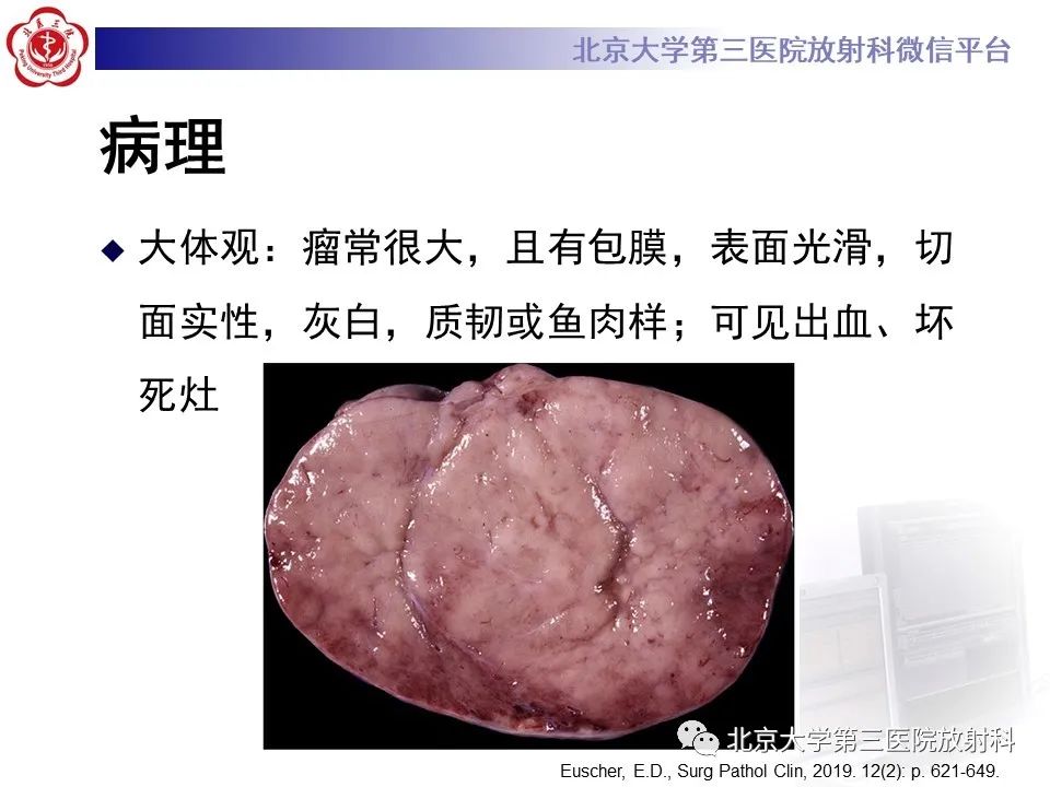 【PPT】卵巢无性细胞瘤-17