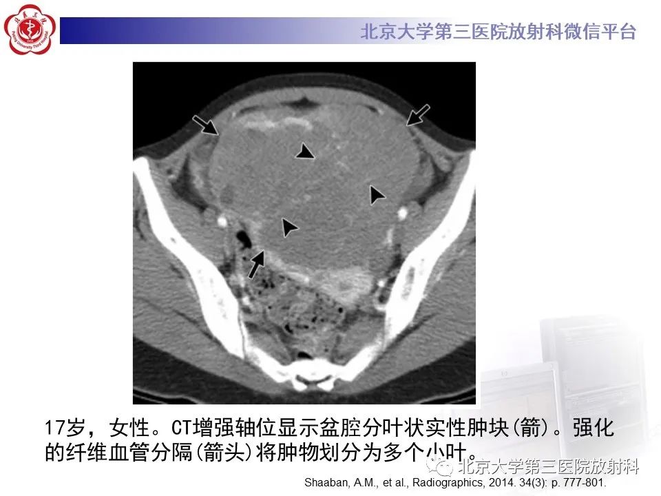 【PPT】卵巢无性细胞瘤-23