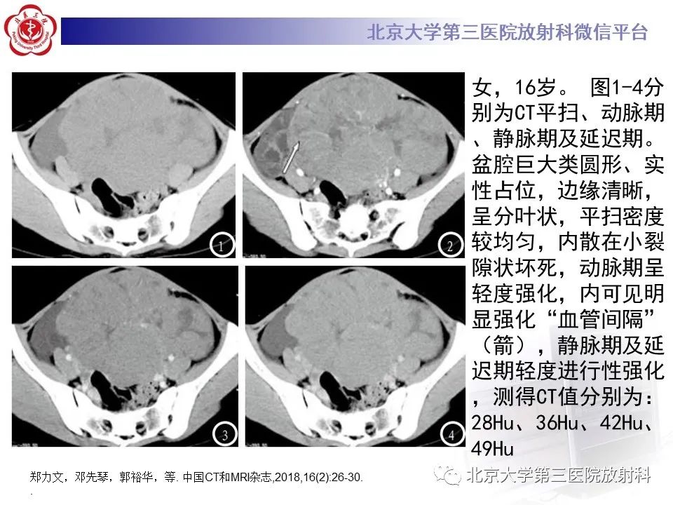 【PPT】卵巢无性细胞瘤-24