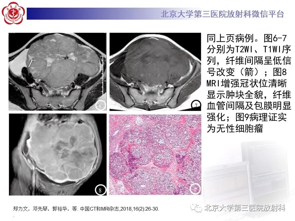 【PPT】卵巢无性细胞瘤-25