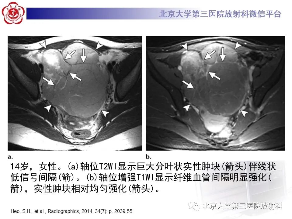 【PPT】卵巢无性细胞瘤-26