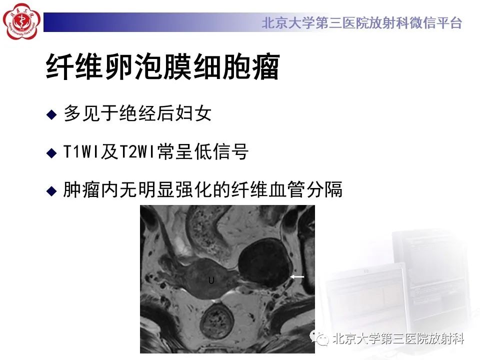 【PPT】卵巢无性细胞瘤-28