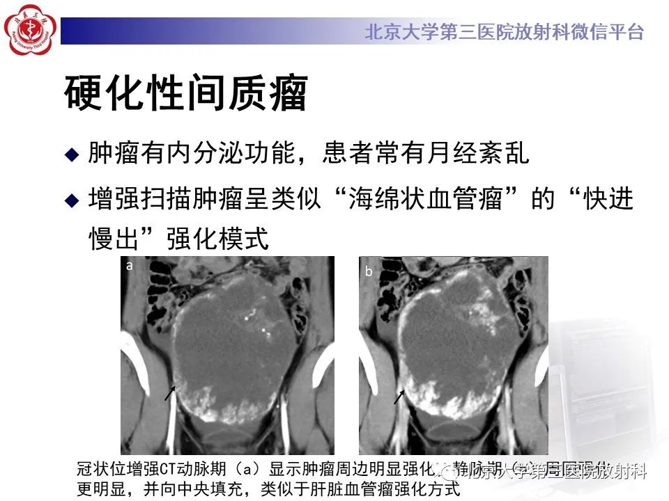 【PPT】卵巢无性细胞瘤-29