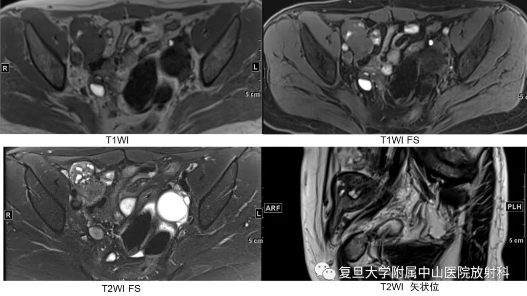【病例】子宫腺肌瘤1例MR影像-3