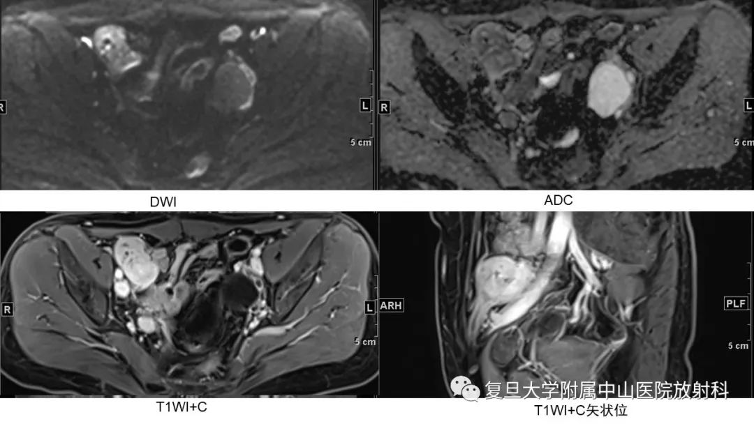 【病例】子宫腺肌瘤1例MR影像-4