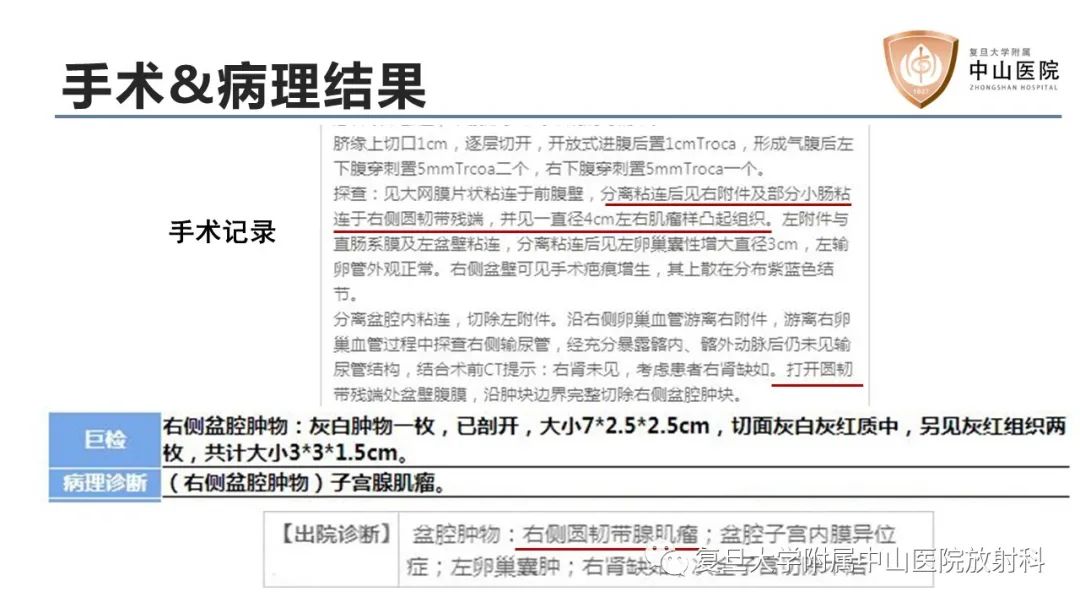 【病例】子宫腺肌瘤1例MR影像-6