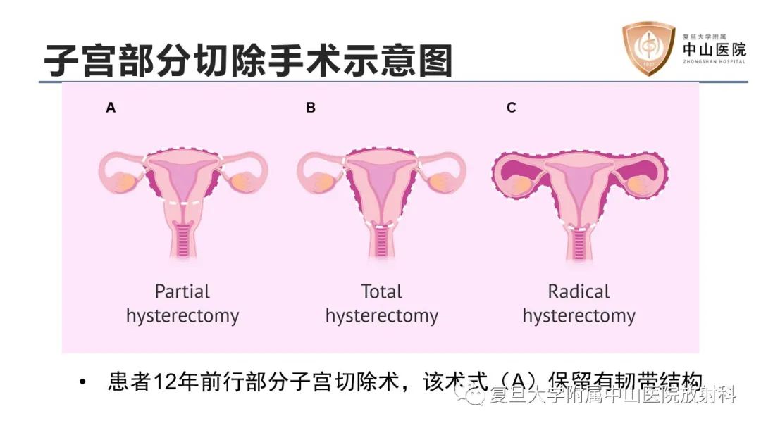 【病例】子宫腺肌瘤1例MR影像-8