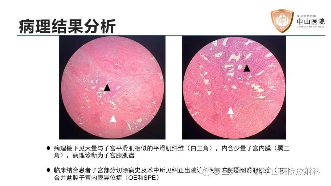 【病例】子宫腺肌瘤1例MR影像-7