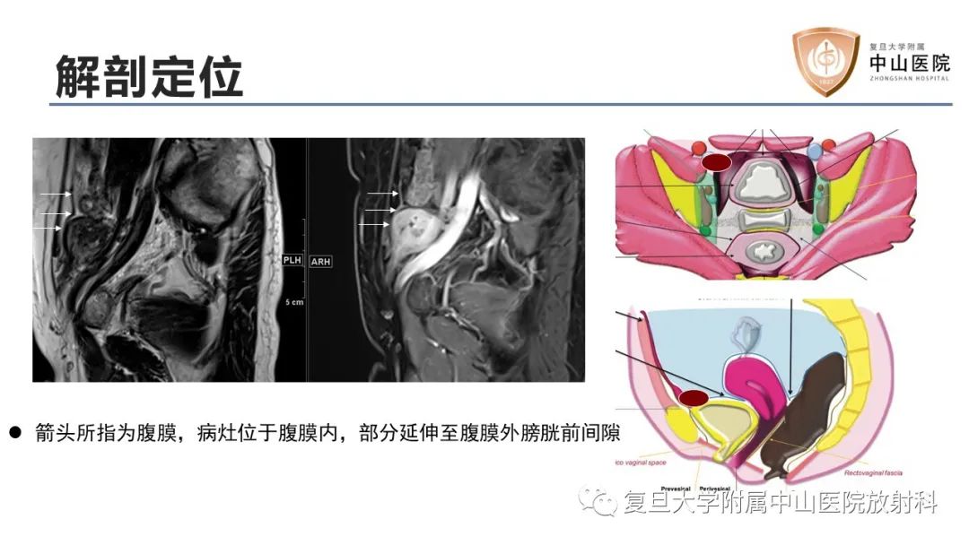 【病例】子宫腺肌瘤1例MR影像-9