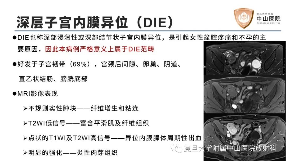 【病例】子宫腺肌瘤1例MR影像-12